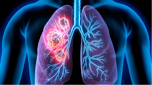 Lung Cancer